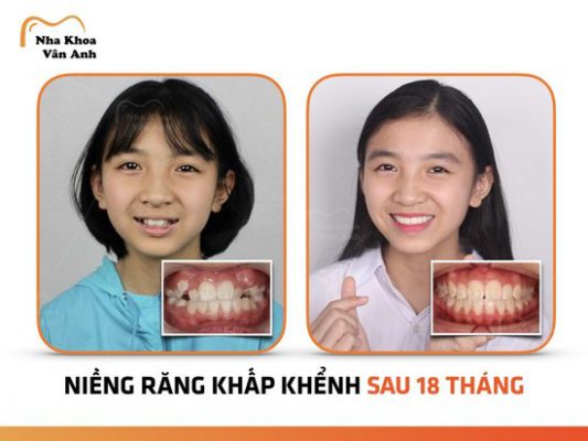 Độ tuổi 12-16 tuổi là thời điểm chỉnh nha lý tưởng nhất